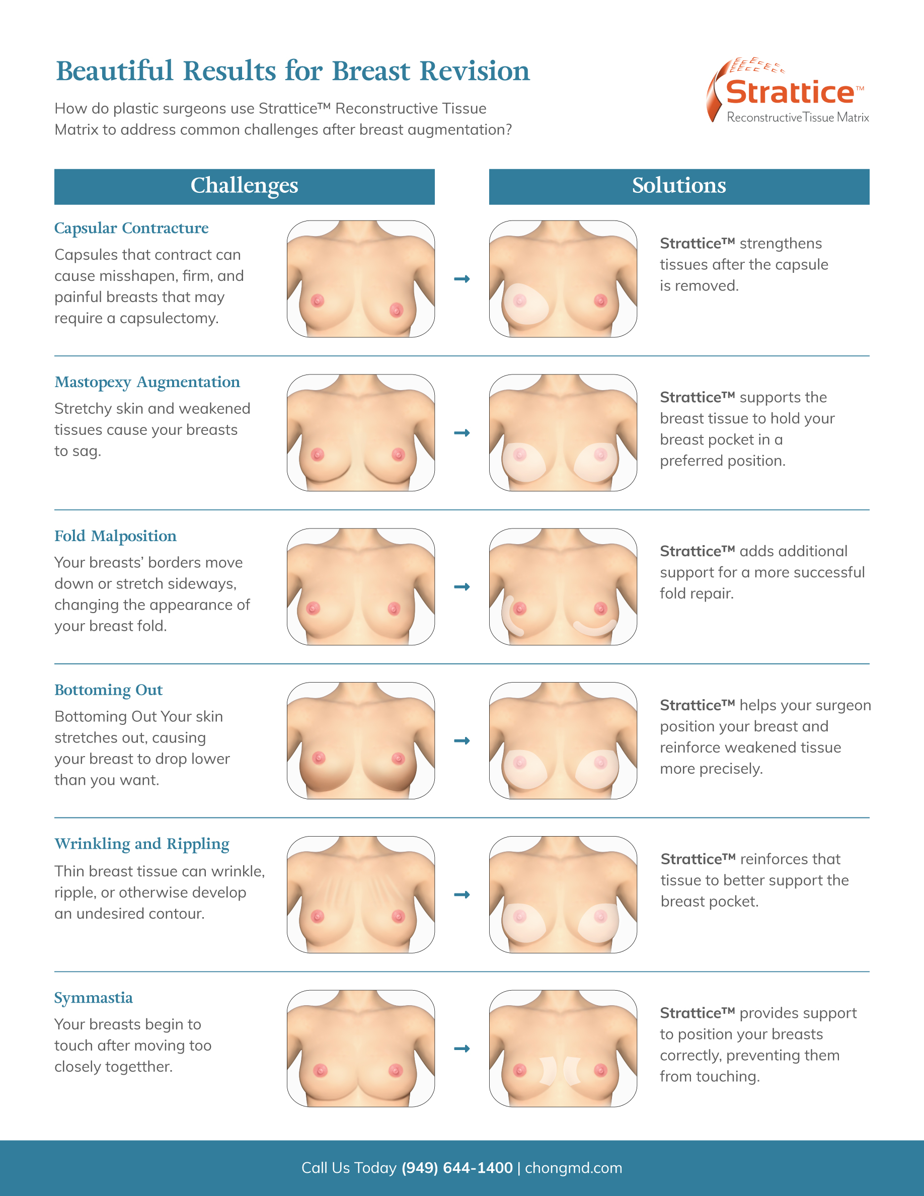 Understanding The Internal Bra