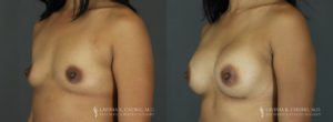 Tummy Tuck Patient 7479 Before & After A