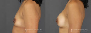 Tummy Tuck Patient 7479 Before & After B