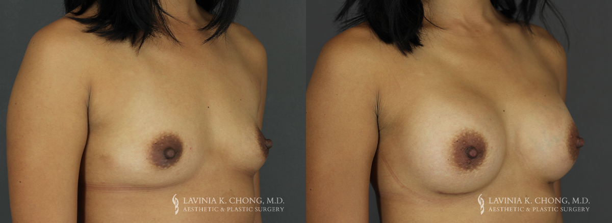 Tummy Tuck Patient 7479 Before & After C