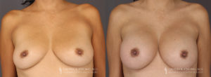 Tummy Tuck Patient 8304 Before & After A