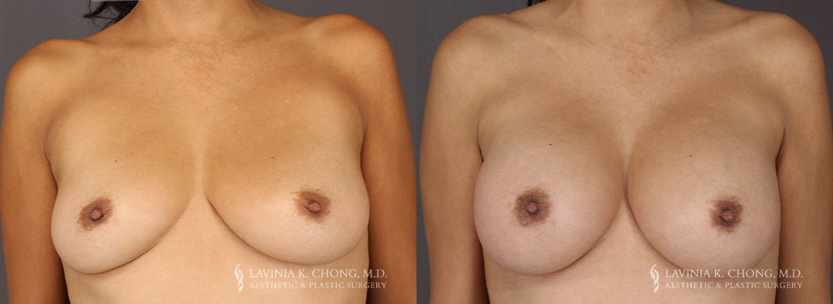 Tummy Tuck Patient 8304 Before & After A