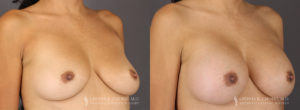 Tummy Tuck Patient 8304 Before & After B