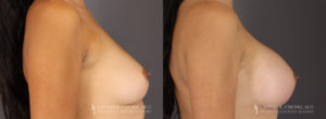 Tummy Tuck Patient 8304 Before & After C