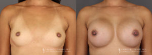 Tummy Tuck Patient 8361 Before & After A