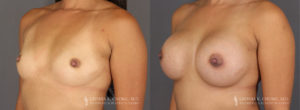 Tummy Tuck Patient 8361 Before & After B