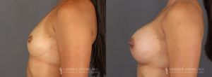 Tummy Tuck Patient 8361 Before & After C