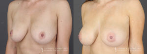 Tummy Tuck Patient 8621 Before & After B