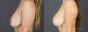 Tummy Tuck Patient 8621 Before & After C
