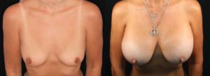 Mommy Makeover Newport Beach Patient 1