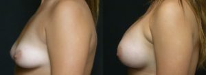 Patient 10.1 Before and After Breast Augmentation