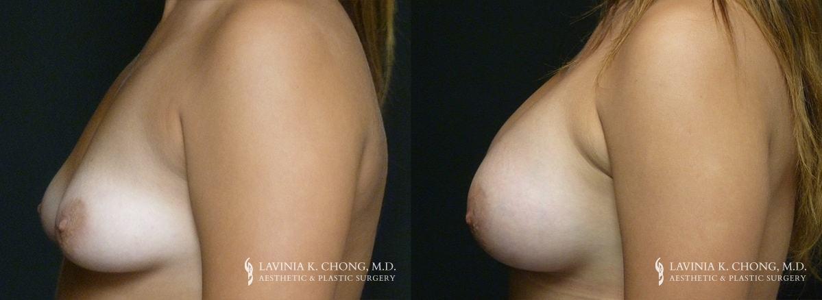 Patient 10.1 Before and After Breast Augmentation