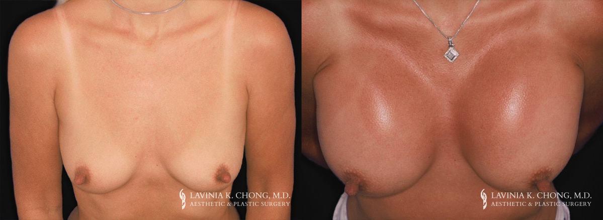 Patient 17.1 Before and After Breast Augmentation