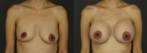 Patient 19 B&A 1