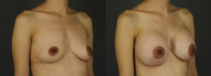 Patient 19 B&A 3