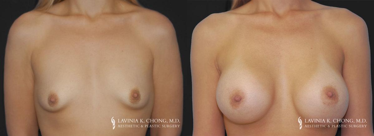 Patient 2 Before and After Breast Augmentation