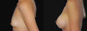 Patient 2.1 Before and After Breast Augmentation