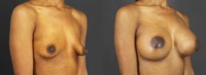 Patient 4 Before and After Breast Augmentation