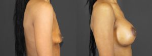 Patient 4.1 Before and After Breast Augmentation