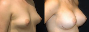 Patient 5.2 Before and After Breast Augmentation