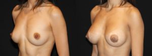 Patient 8.1 Before and After Breast Augmentation