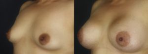 Patient 9.2 Before and After Breast Augmentation
