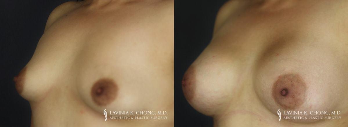 Patient 9.2 Before and After Breast Augmentation