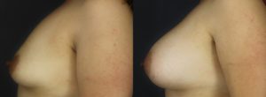 Patient 9.3 Before and After Breast Augmentation