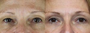 Blepharoplasty Newport Beach Patient 1