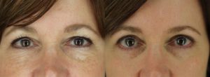 Eyelid Surgery Newport Beach Patient 1