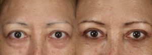 Eyelid Surgery Newport Beach Patient 2