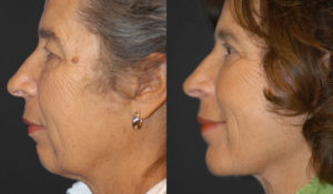 Facelift newport beach patient 1 1 | lavinia k chong m D