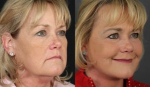 Facelift Newport Beach Patient 10