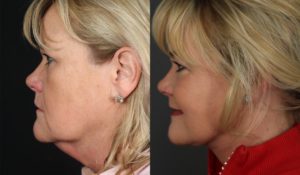 Facelift Newport Beach Patient 10.1