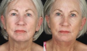 Facelift Newport Beach Patient 6