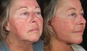 Facelift Newport Beach Patient 9