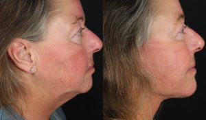 Facelift Newport Beach Patient 9.1