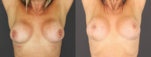 Implant Exchange 6064 B&A A