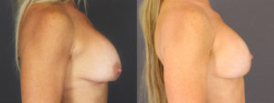 Implant Exchange 6064 B&A B