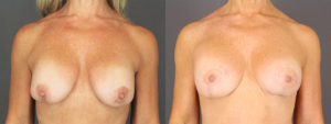 Implant Exchange 6064 B&A C