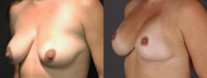 Implant Exchange 7692 B&A A