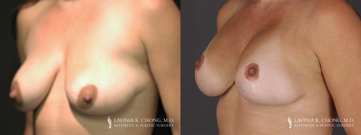 Implant Exchange 7692 B&A A