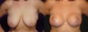Mommy Makeover Newport Beach Patient 2