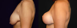 Mommy Makeover Newport Beach Patient 2.1