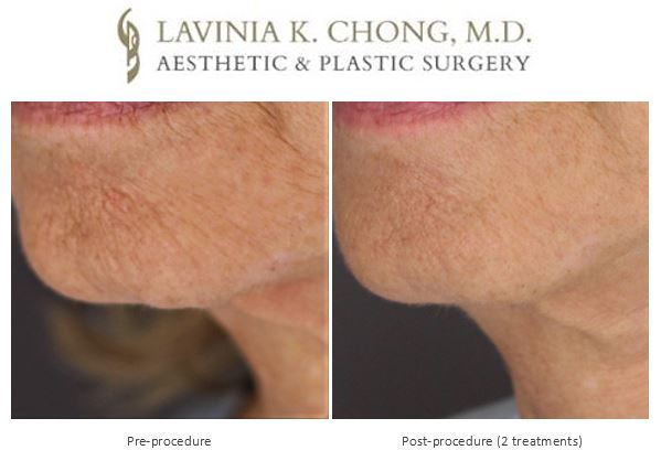 Effective treatments for improving skin tone and texture with female plastic surgeon Dr. Lavinia Chong of Newport Beach.