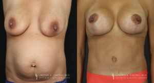 Mommy Makeover Patient 6173 Before & After A
