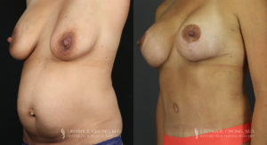 Mommy Makeover Patient 6173 Before & After B