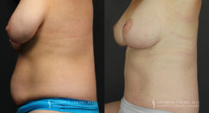 Mommy Makeover Patient 6235 Before & After A