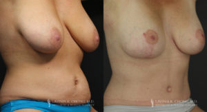 Mommy Makeover Patient 6235 Before & After B