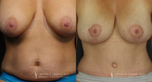Mommy Makeover Patient 6235 Before & After C